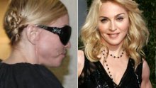 Madonna ugrađuje trakice u lice da izgleda mlađe