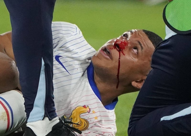 Šok za Francuze; Mbappe slomio nos i trebao je na operaciju. Ali ipak ostaje na Euru!