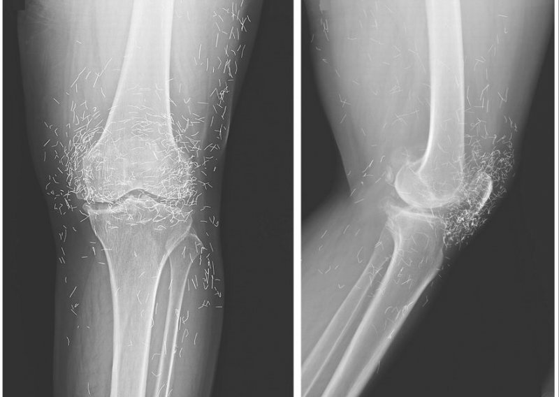 Rendgenska snimka otkrila: Koljeno puno vrhova igala!