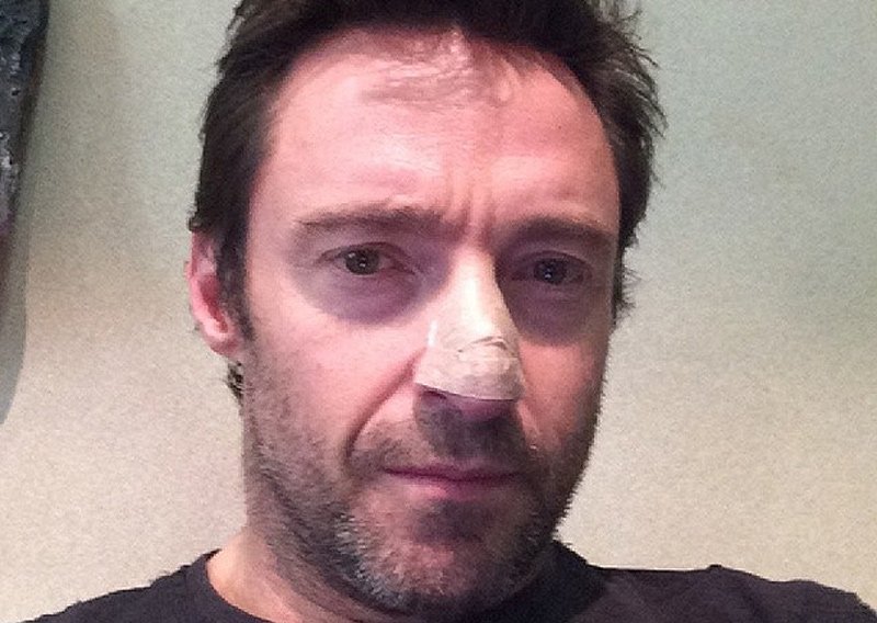 Hugh Jackman objavio da ima rak