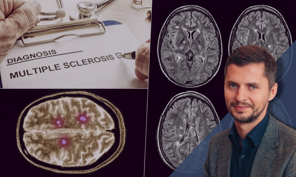 Dr. Mario Habek: Multipla skleroza najvjerojatnije počinje i 10 godina prije prve kliničke manifestacije