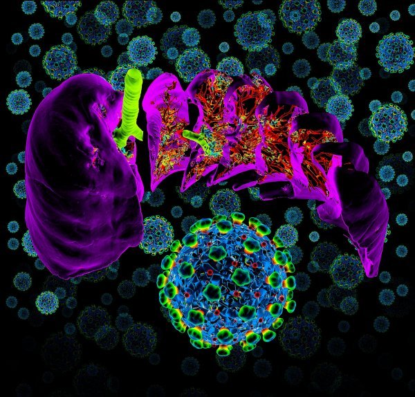 Pluća zahvaćena koronavirusom koji izaziva COVID-19