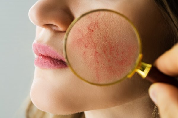 Rosacea se češće pojavljuje kod ljudi sa svijetlom kožom