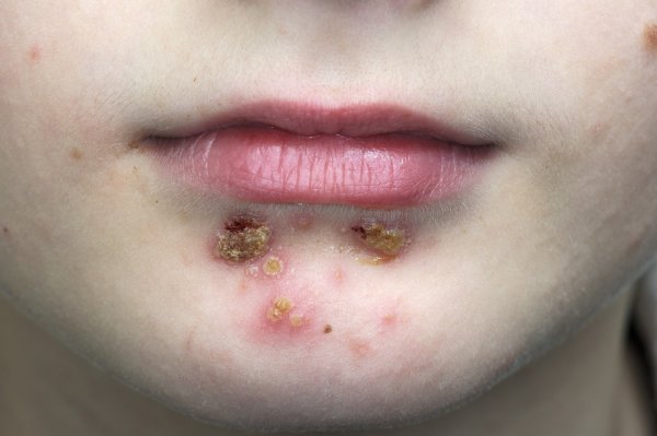 Impetigo