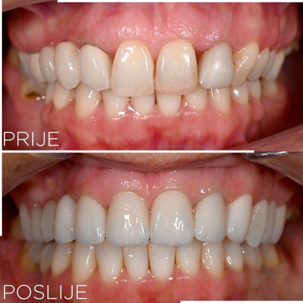 Često je kombinacija nekoliko usluga idealno rješenje za dentalne probleme. Kod osobe na slici je problem nepravilnog zagriza te estetike zubi riješen ljuskicama, krunicama i implantatima. 